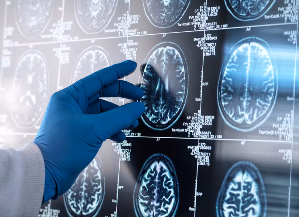 Cerebro Inflamado